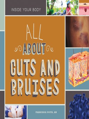 cover image of All About Cuts and Bruises